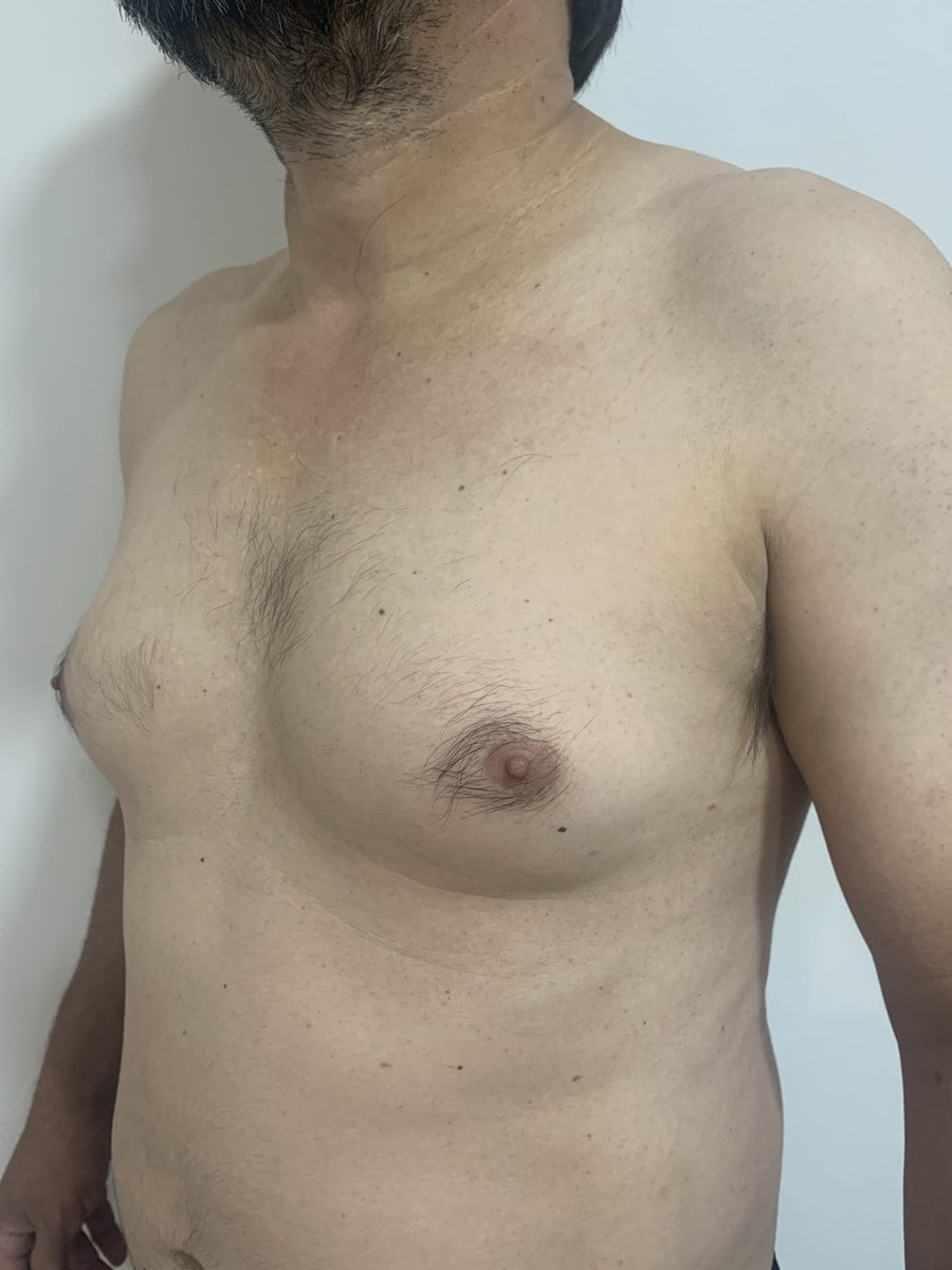 Antes - grau 2